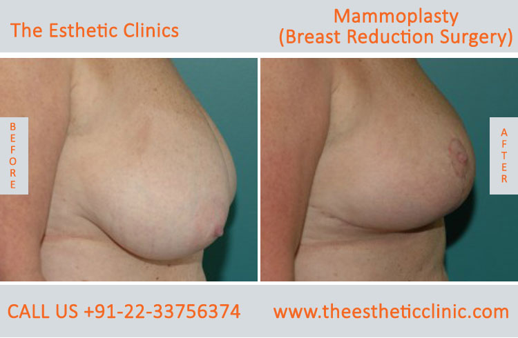 Mammoplasty, Breast Reduction Surgery before after photos in mumbai india (3)